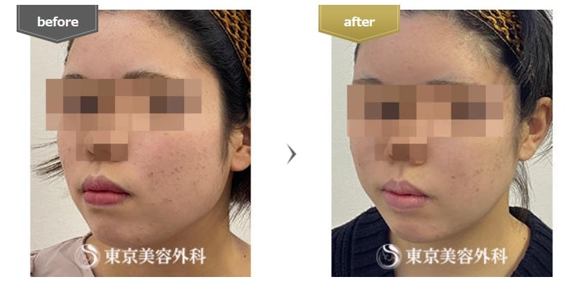 エラボトックスでおすすめでうまい東京美容外科の症例