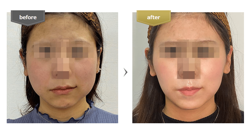 札幌でエラボトックスが安いおすすめの麻生美容外科クリニックの症例
