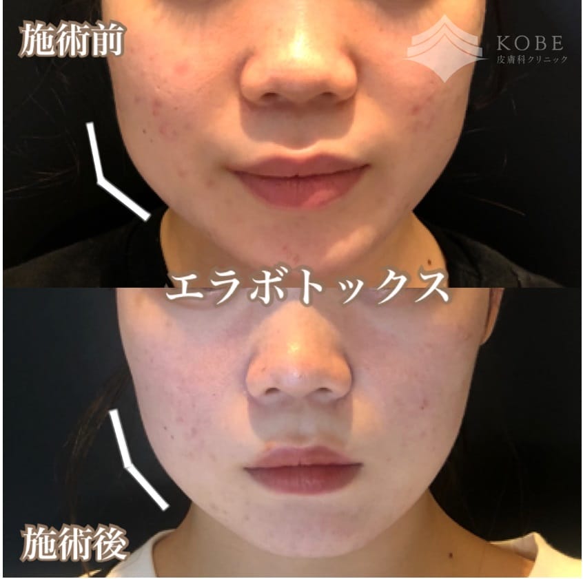 神戸でエラボトックスが安い上手いKOBE皮膚科クリニック神戸東灘院の症例