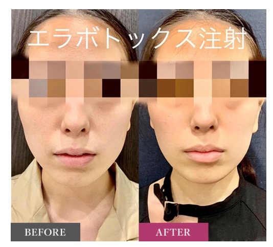 名古屋でエラボトックスが安いおすすめのLULA美容クリニックのビフォーアフター