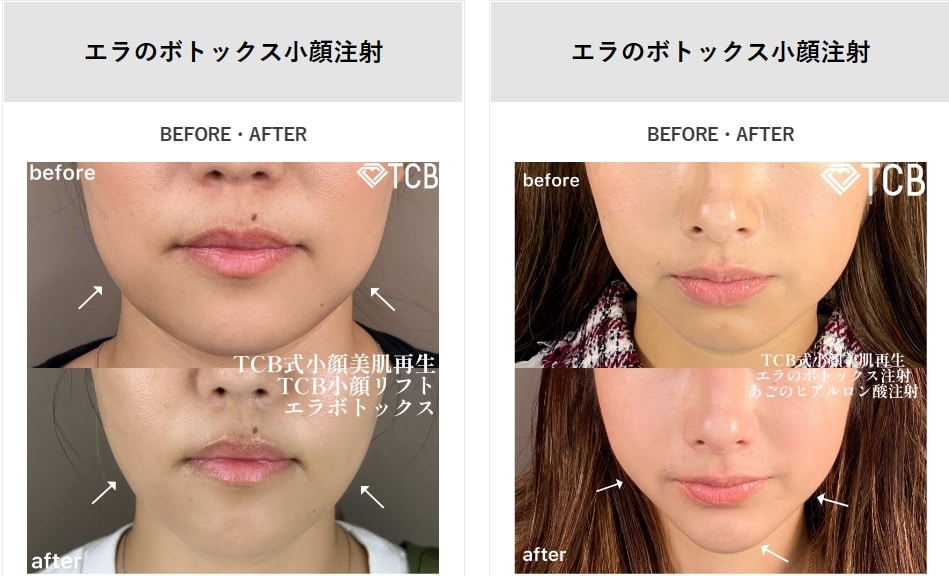 エラボトックスでおすすめでうまいTCB東京中央美容外科の症例