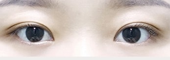 中神眼科形成外科の二重整形症例